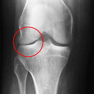 Diagnosis - Partial knee replacement 