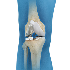 Unicompartmental Knee Replacement